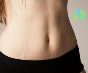 עור מקומט בבטן: מתיחת בטן ללא ניתוח