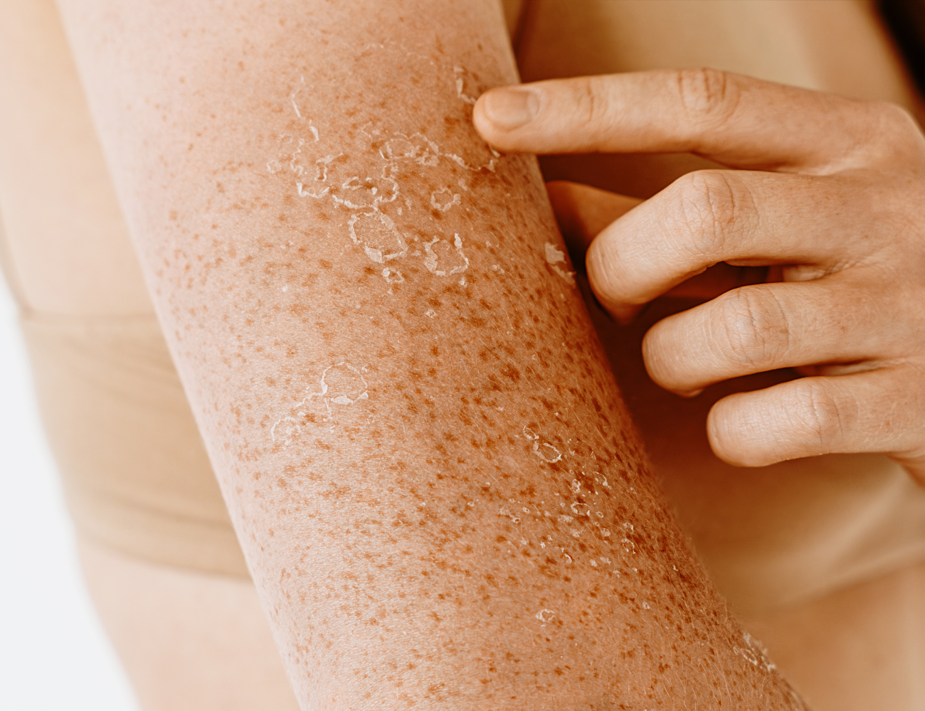 עור רגיש לשמש: קרם מומלץ לעור רגיש לשמש